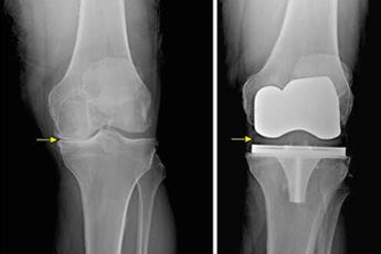 Osteoarthritis & Joint Replacement
