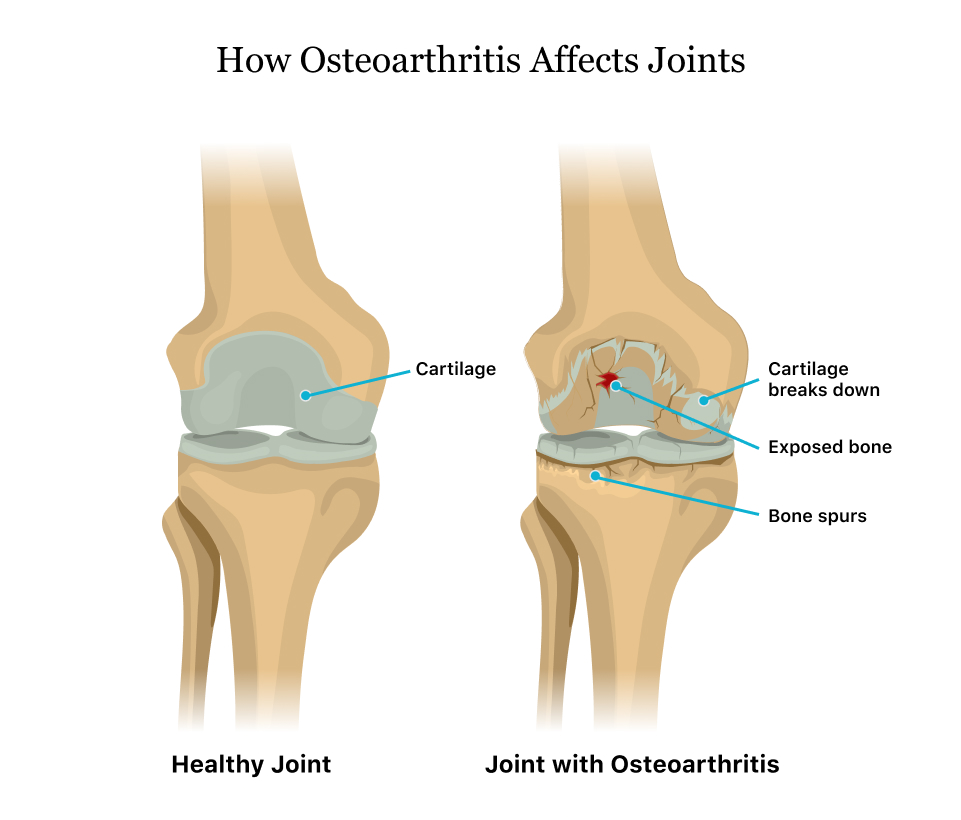 Osteoarthritis 