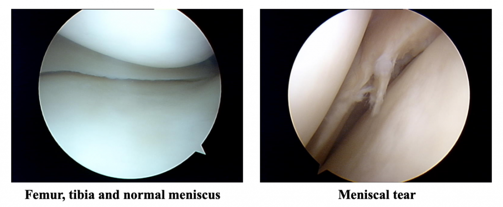 Meniscal Injuries