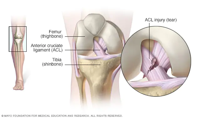 ACL Tears